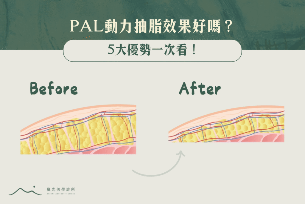 PAL動力抽脂效果好嗎？5大優勢一次看！